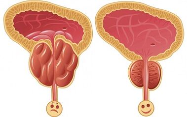 Como funciona Prostalix para a prostatite antes e despois do tratamento