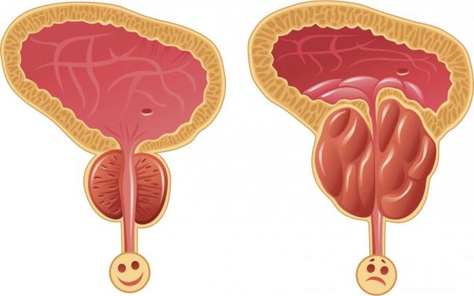 próstata sa e inflamada con prostatite