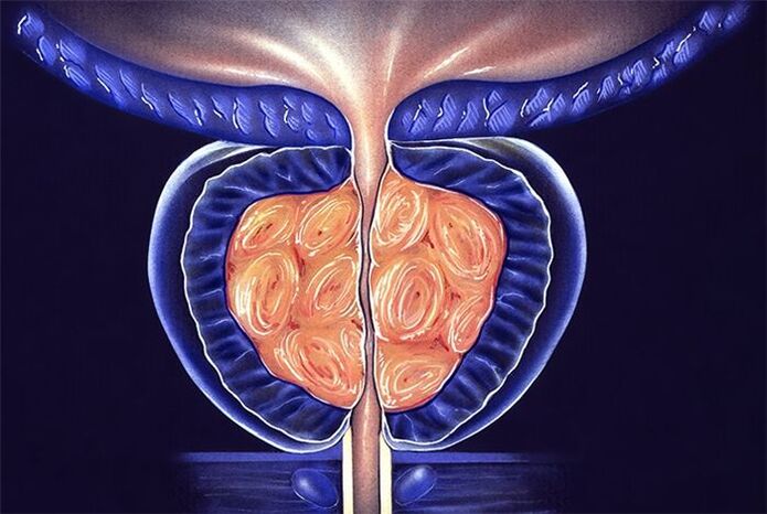 Síntomas e tratamento da prostatite