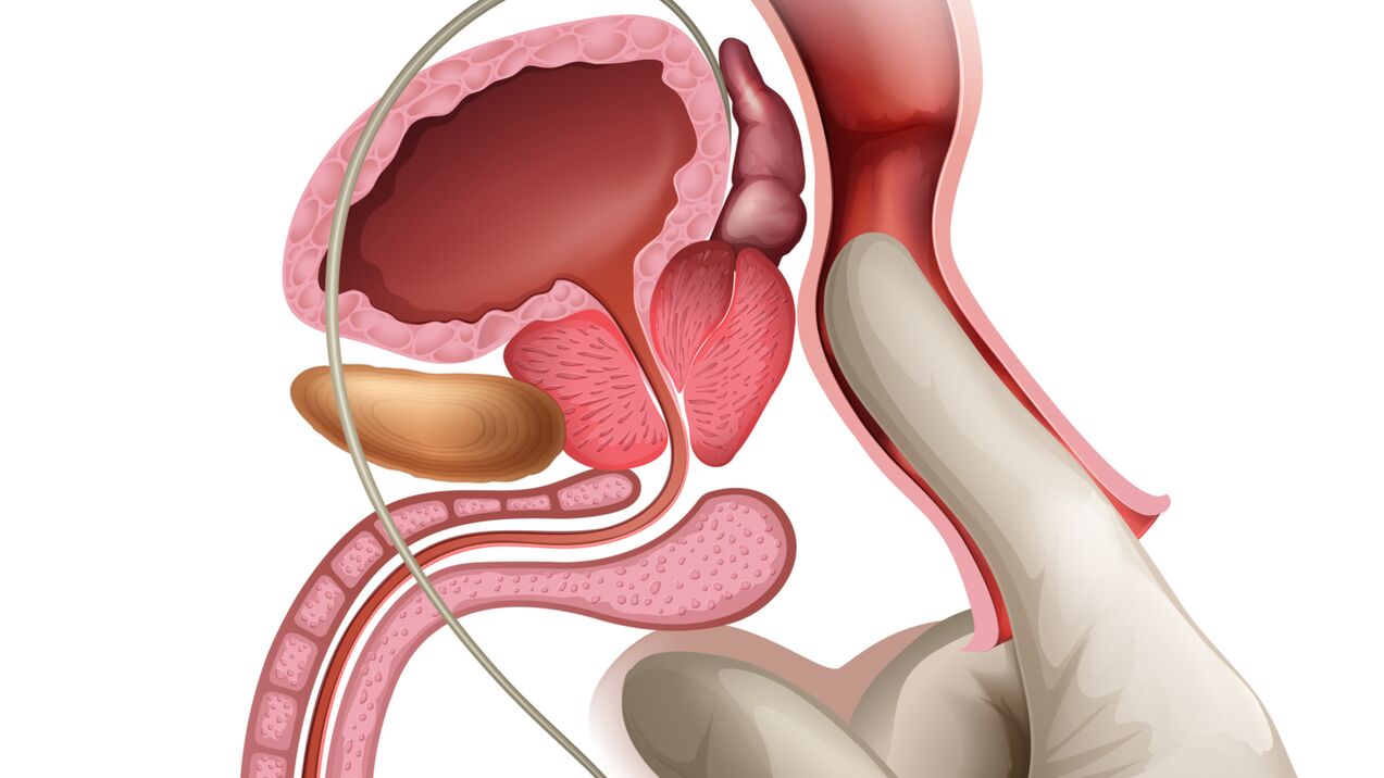 A masaxe prostática é un método eficaz para tratar a prostatite conxestiva